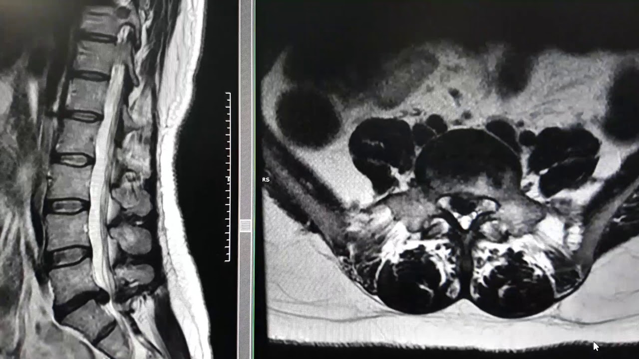 se ve una hernia en una radiografia