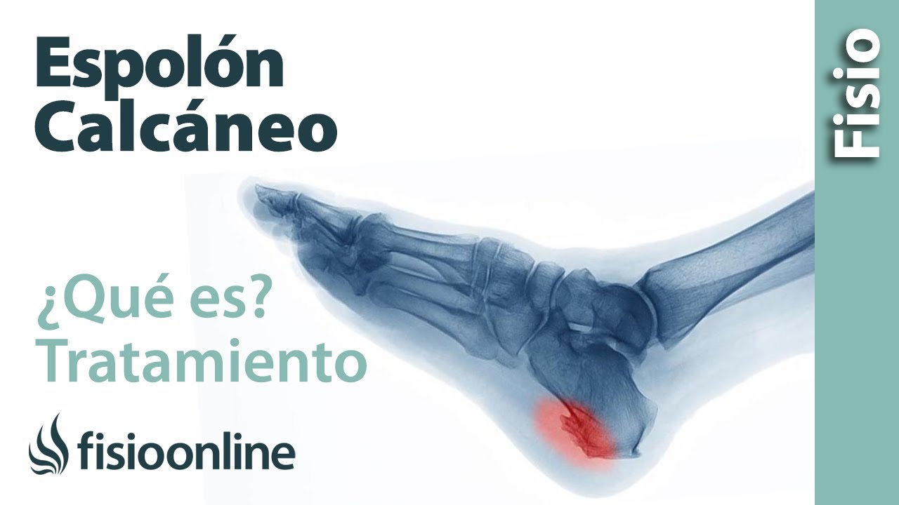 tiempo de baja por espolón calcáneo