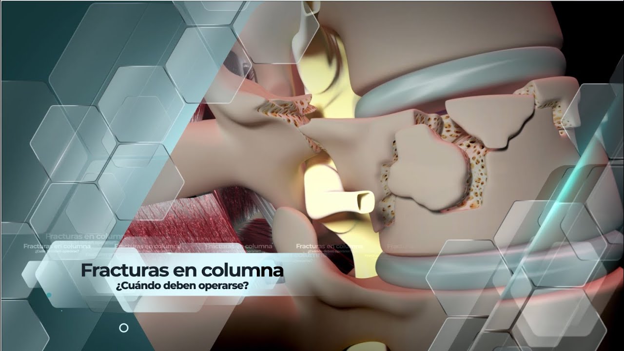 tiempo de baja por fractura vertebral