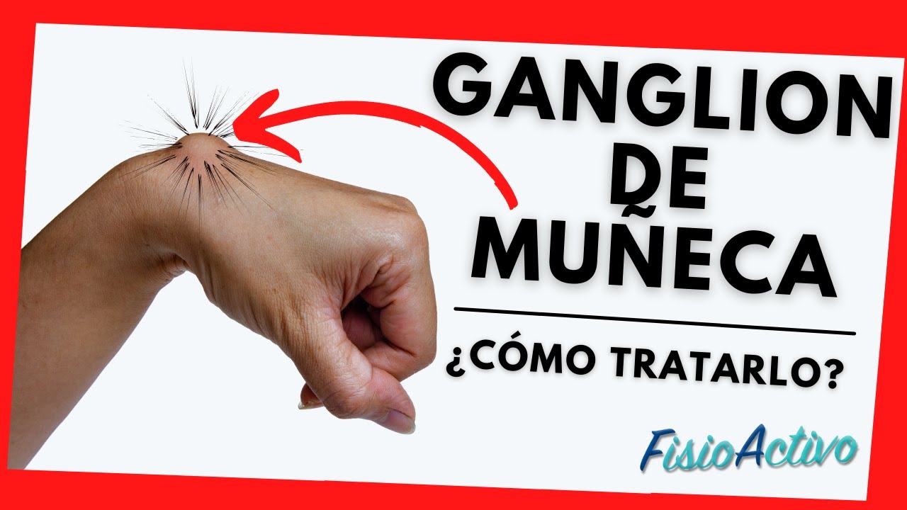 tiempo de baja por operación ganglión