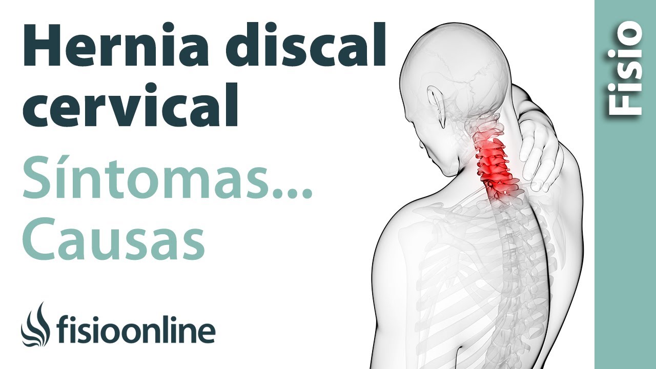 tipos de hernia de disco cervical