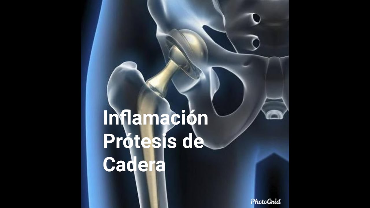 tobillo hinchado despues de operacion de cadera