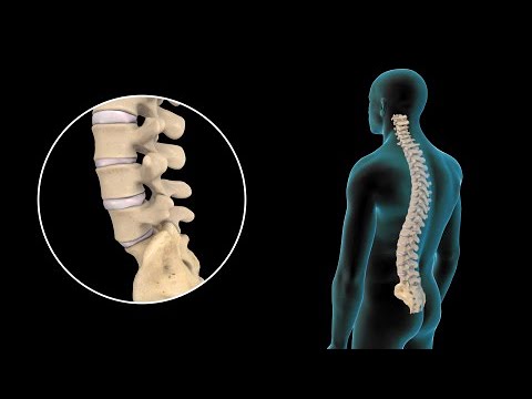 tratamiento para el desgaste de los discos de la columna
