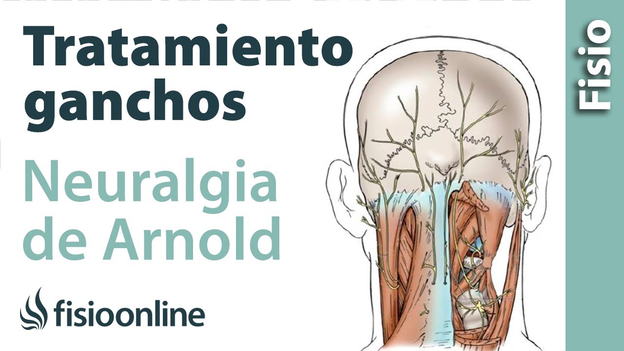 tratamiento para la neuralgia de arnold