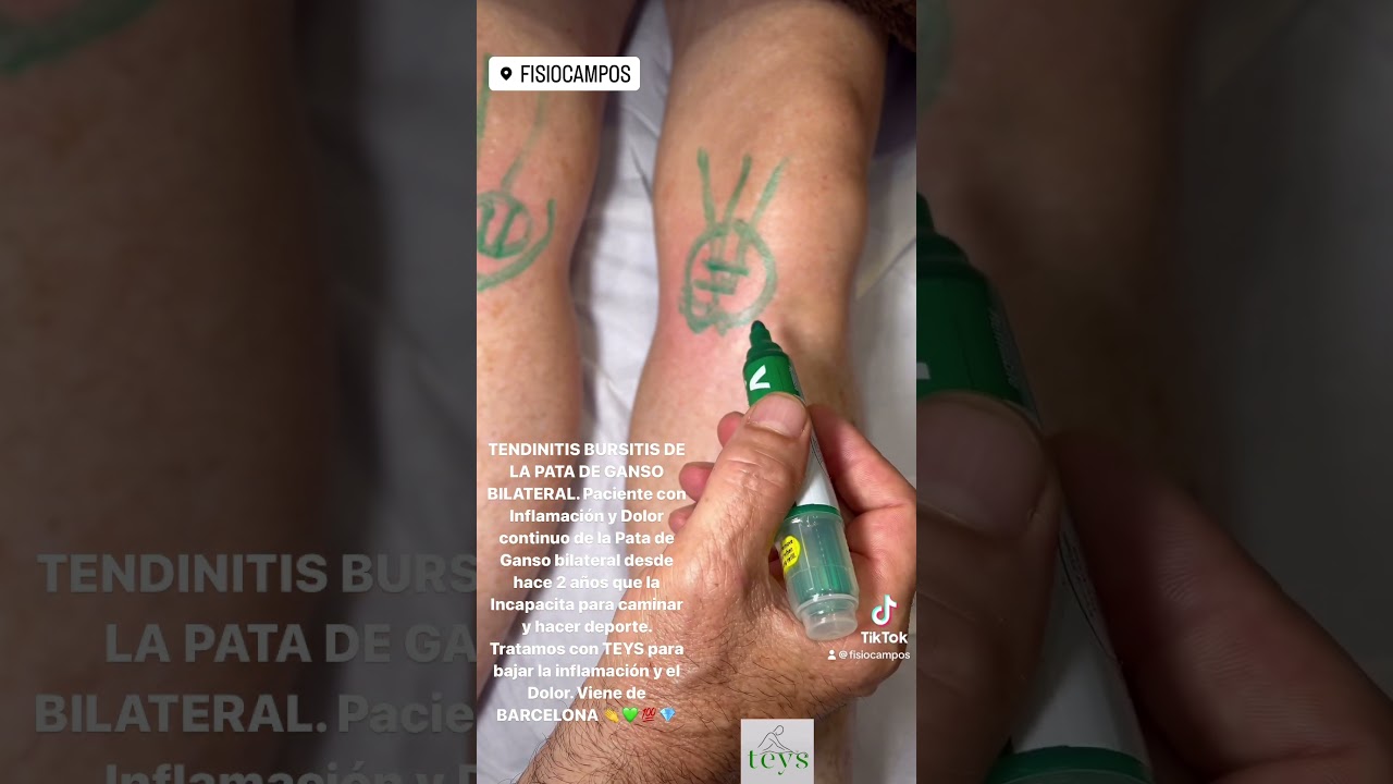 bursitis de la pata de ganso