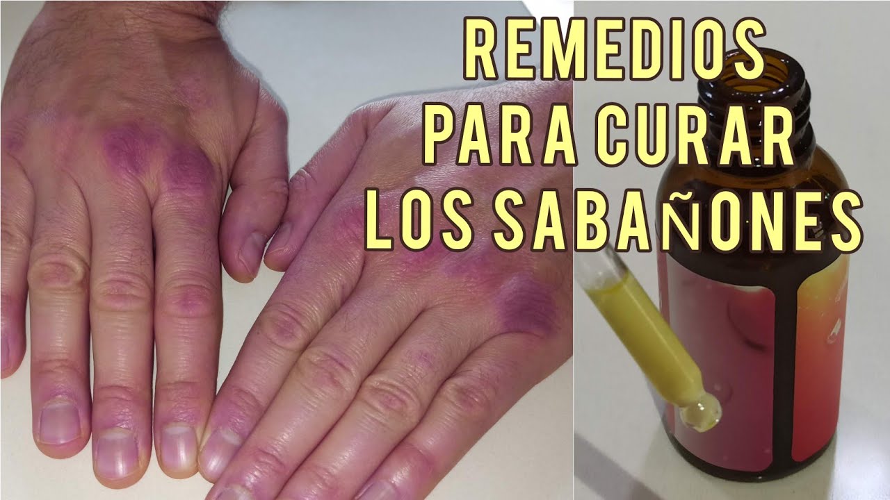 como aliviar el dolor de los sabañones