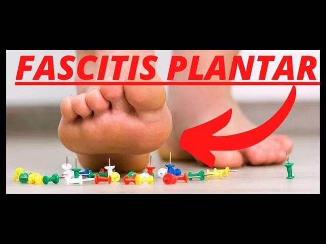 cuanto tiempo dura la fascitis plantar