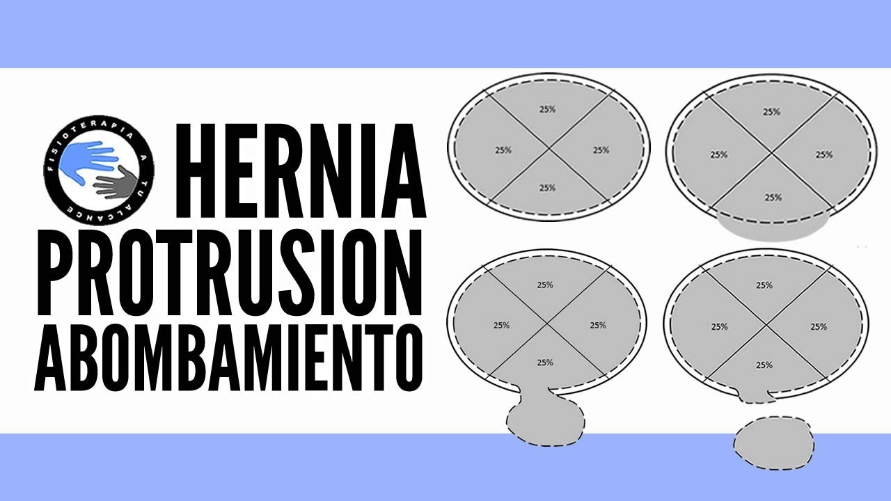 diferencia entre hernia y extrusión discal