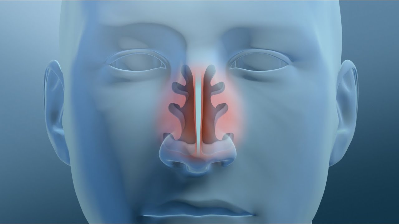 engrosamiento de la mucosa de los cornetes