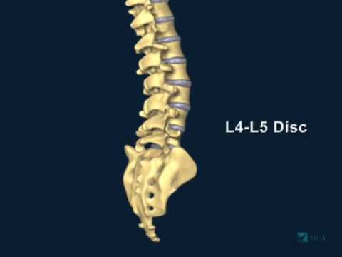 hernia discal postero central l4 l5