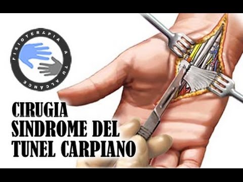 operacion del tunel carpiano mano derecha