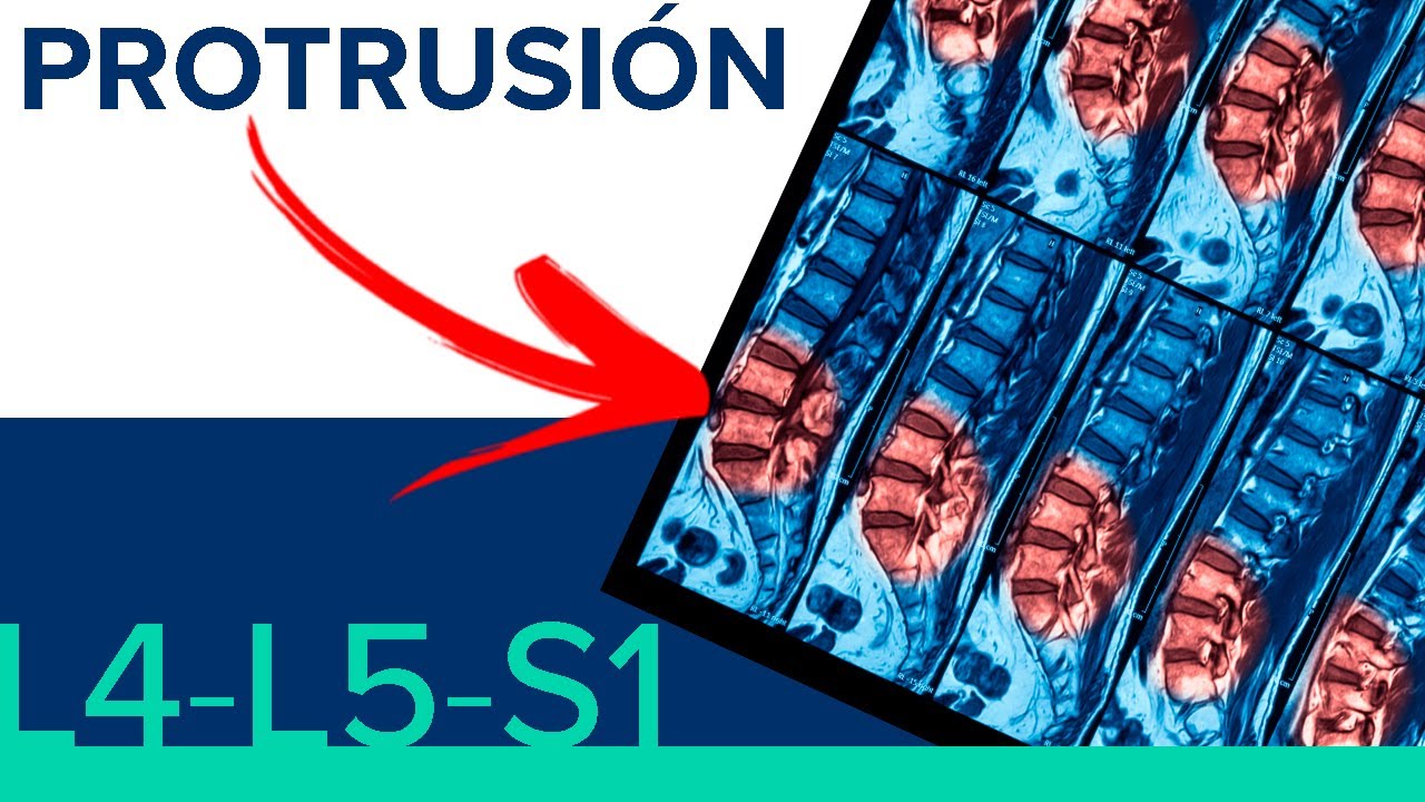 protrusion posterocentral del disco l5 s1