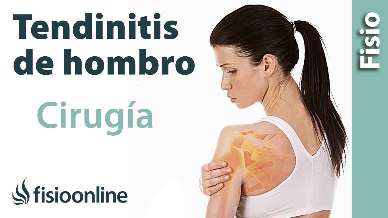 se opera la tendinitis de hombro