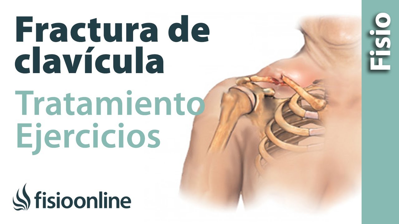 tiempo de baja por fractura de clavícula